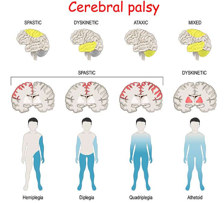 Cerebral Palsy. Human Brain With Area Mixed, Ataxic, Dyskinetic,